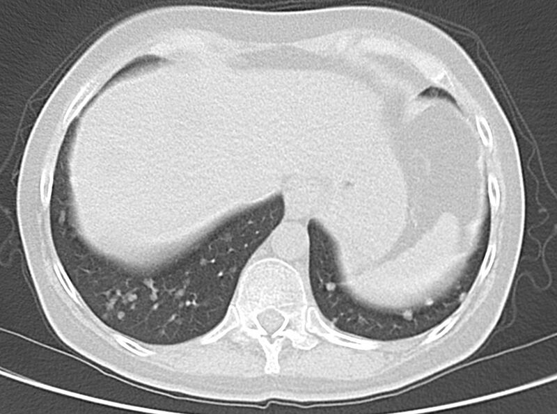 File:Adenosquamous lung carcinoma (Radiopaedia 22035-22030 lung window 51).jpg