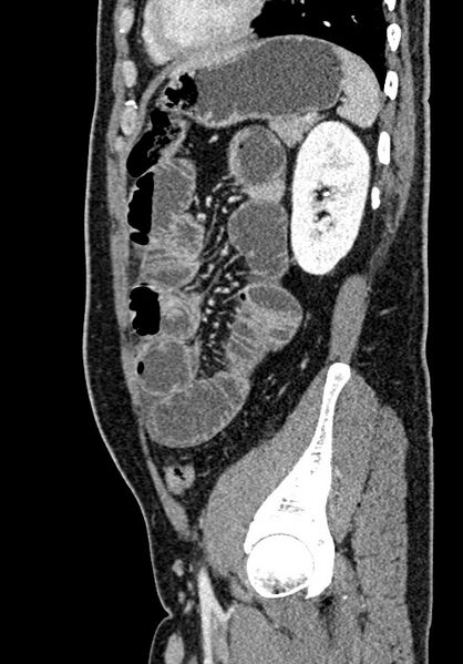 File:Adhesional small bowel obstruction (Radiopaedia 58900-66131 Sagittal C+ portal venous phase 185).jpg