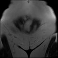 Adnexal multilocular cyst (O-RADS US 3- O-RADS MRI 3) (Radiopaedia 87426-103754 Coronal T2 2).jpg