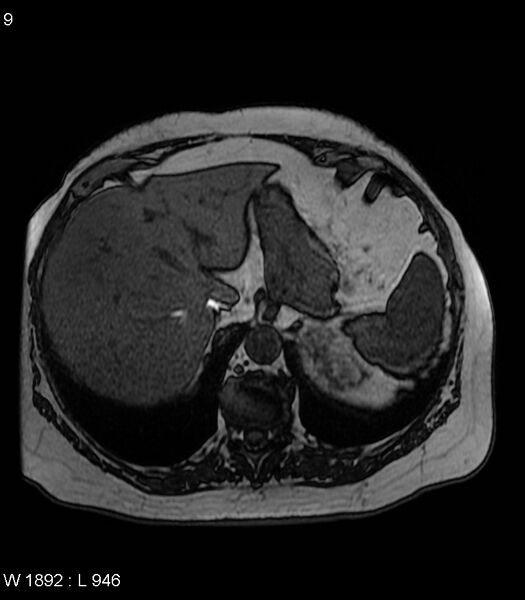 File:Adrenal myelolipoma (Radiopaedia 6765-7961 Axial T1 out-of-phase 9).jpg
