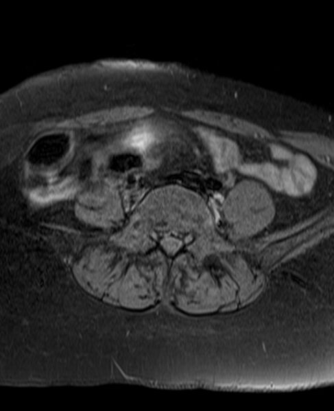 File:Adult granulosa cell tumor of the ovary (Radiopaedia 71581-81950 Axial T1 fat sat 3).jpg