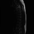 Aggressive vertebral hemangioma (Radiopaedia 39937-42404 Sagittal T2 5).png