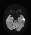 Aicardi syndrome (Radiopaedia 66029-75205 Axial DWI 8).jpg