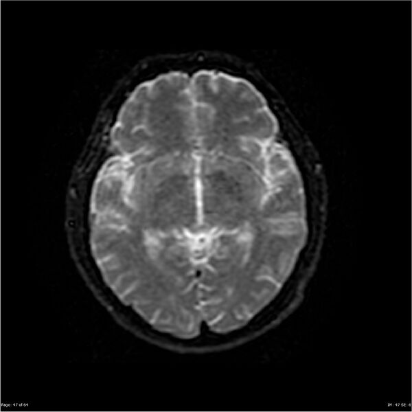 File:Amnestic syndrome secondary to hypoxic brain injury (Radiopaedia 24743-25004 DWI 47).jpg