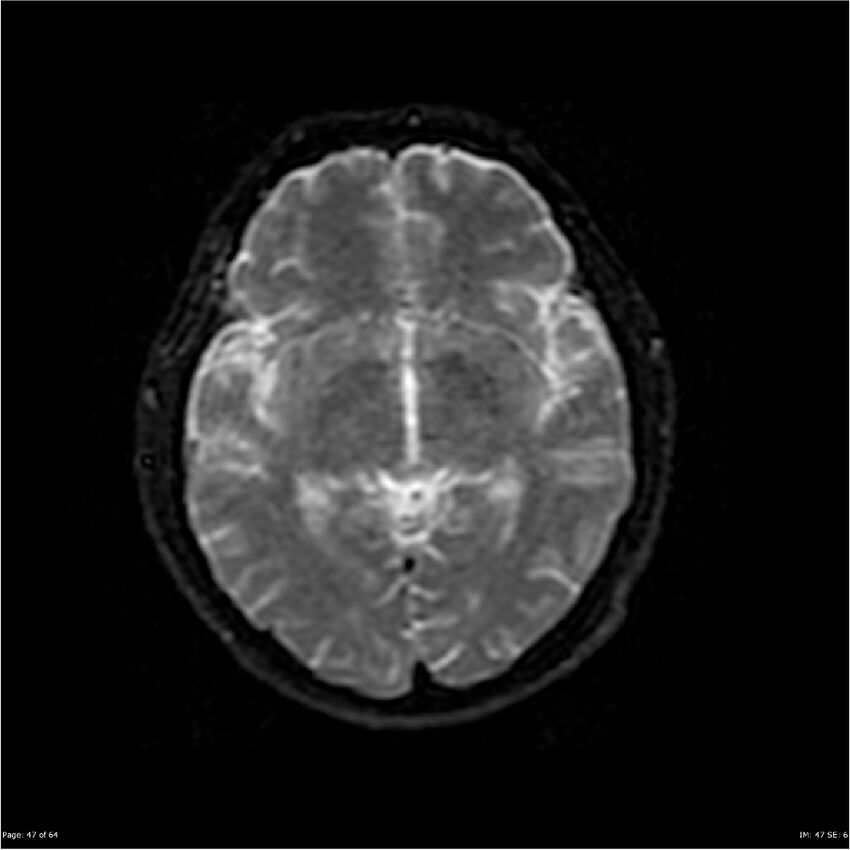 Amnestic syndrome secondary to hypoxic brain injury (Radiopaedia 24743-25004 DWI 47).jpg