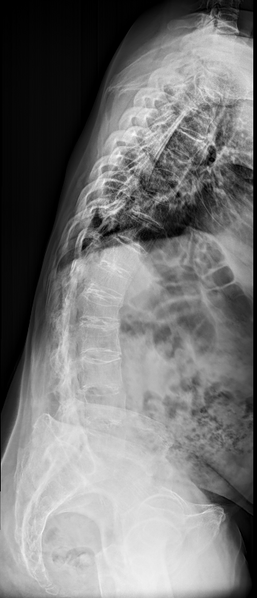 File:Ankylosing spondylitis with dagger sign (Radiopaedia 61271-69171 Lateral 1).PNG