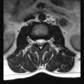 Ankylosing spondylitis with zygapophyseal arthritis (Radiopaedia 38433-40516 Axial T2 14).jpg