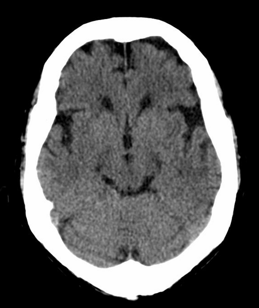 File:Anomalous intracranial venous drainage (Radiopaedia 28161-28418 Axial 31).png