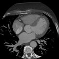 Anomalous origin of left circumflex artery from right coronary sinus (Radiopaedia 72563-83117 A 33).jpg
