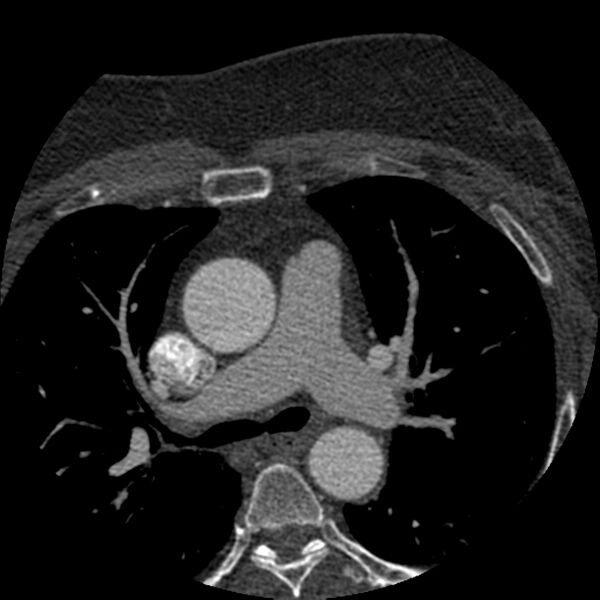 File:Anomalous origin of left circumflex artery from right coronary sinus (Radiopaedia 72563-83117 B 4).jpg