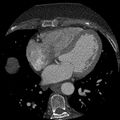 Anomalous origin of left circumflex artery from right coronary sinus (Radiopaedia 72563-83117 B 91).jpg