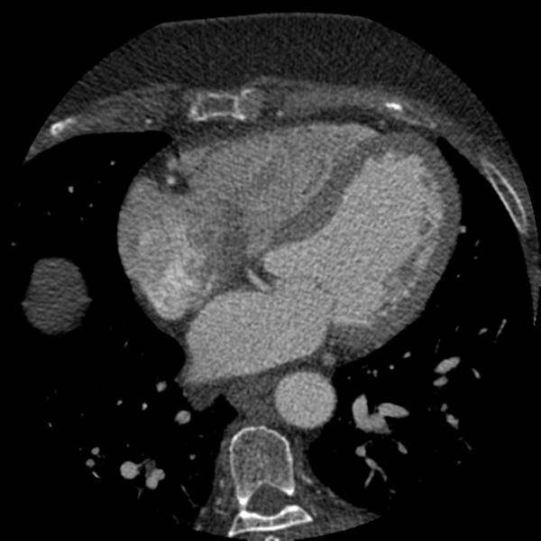 File:Anomalous origin of left circumflex artery from right coronary sinus (Radiopaedia 72563-83117 B 91).jpg