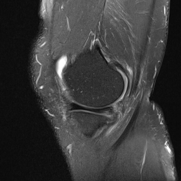 File:Anterior cruciate ligament tear - ramp lesion (Radiopaedia 71883-82322 Sagittal PD fat sat 21).jpg
