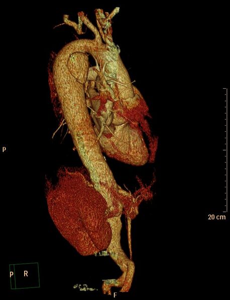File:Aortic aneurysm and penetrating ulcer (Radiopaedia 23590-23704 3D reconstruction 9).jpg
