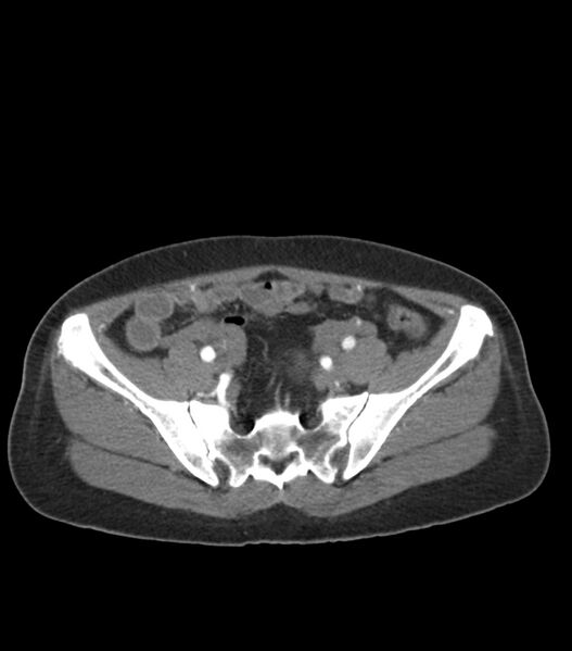 File:Aortic dissection with renal ischemia (Radiopaedia 76573-88338 A 95).jpg