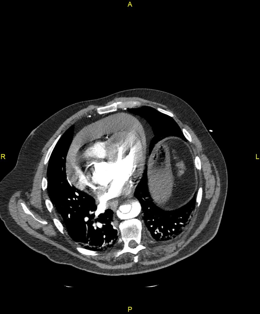 Aortic rupture (Radiopaedia 88822-105594 B 157).jpg