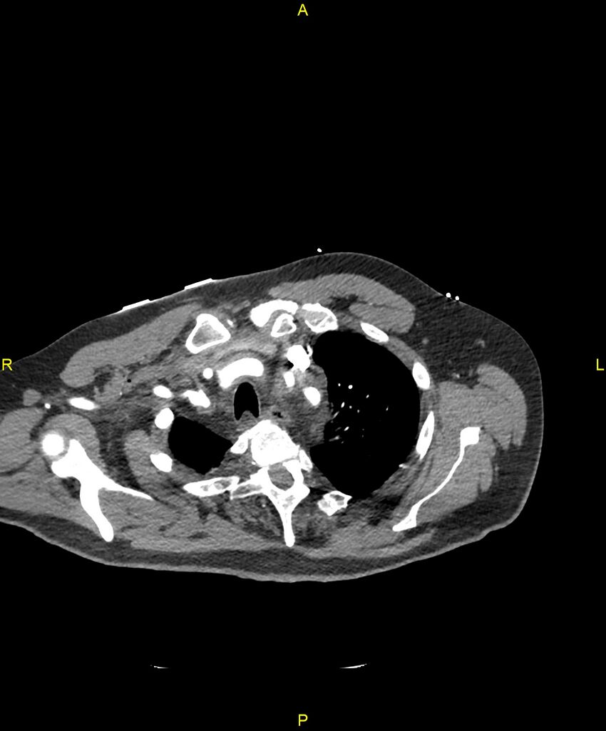 Aortic rupture (Radiopaedia 88822-105594 B 40).jpg