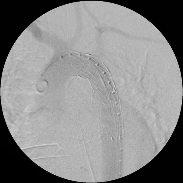 File:Aortic transection and subclavian steal (Radiopaedia 8711-9517 Stent 9).jpg