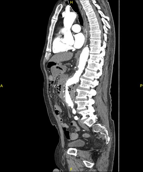 File:Aortoenteric fistula (Radiopaedia 84308-99603 C 191).jpg