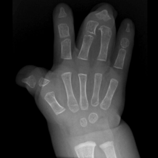 File:Apert syndrome with syndactyly (Radiopaedia 10315-10833 Frontal 1).jpg