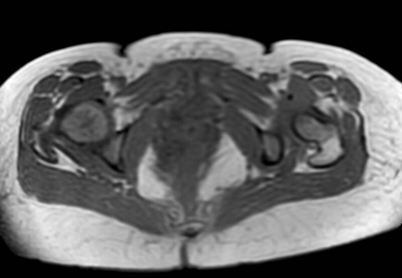 File:Appendicitis in gravida (MRI) (Radiopaedia 89433-106395 Axial T1 in-phase 69).jpg