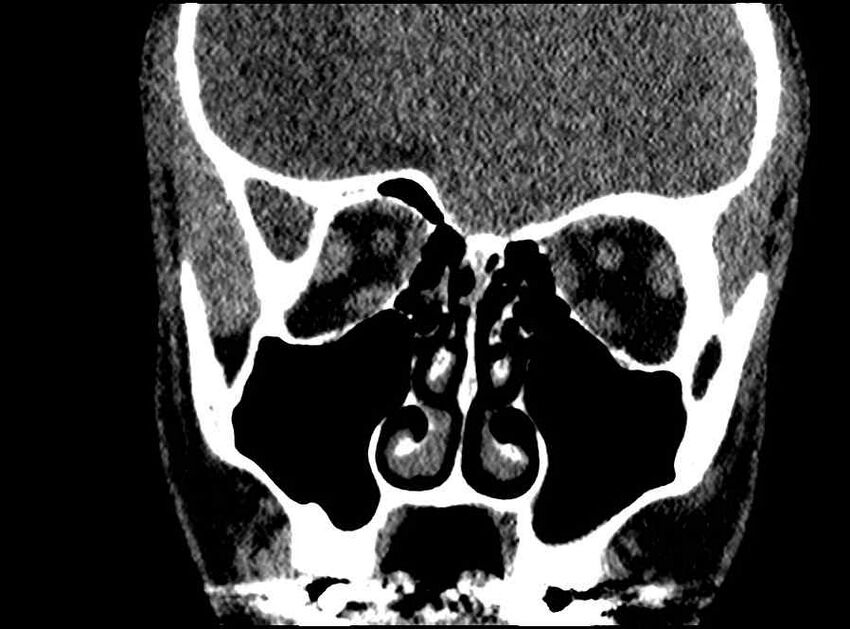 Arachnoid cyst- extremely large (Radiopaedia 68741-78450 Coronal bone window 46).jpg