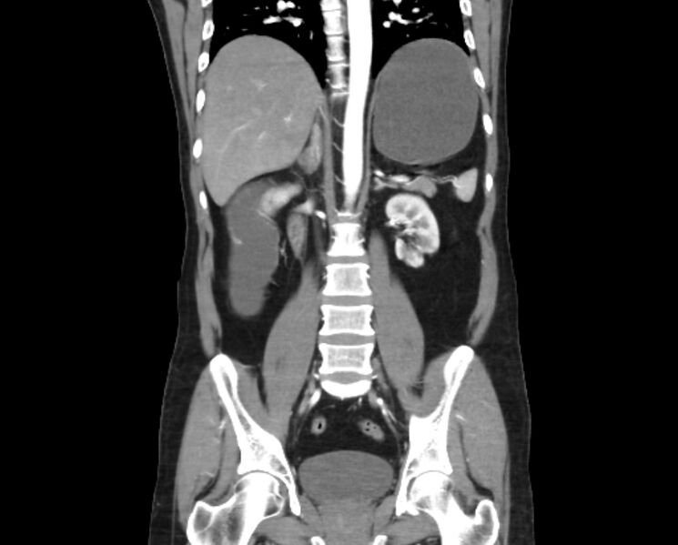 File:Arterial occlusive mesenteric ischemia (Radiopaedia 84641-100060 B 34).jpg