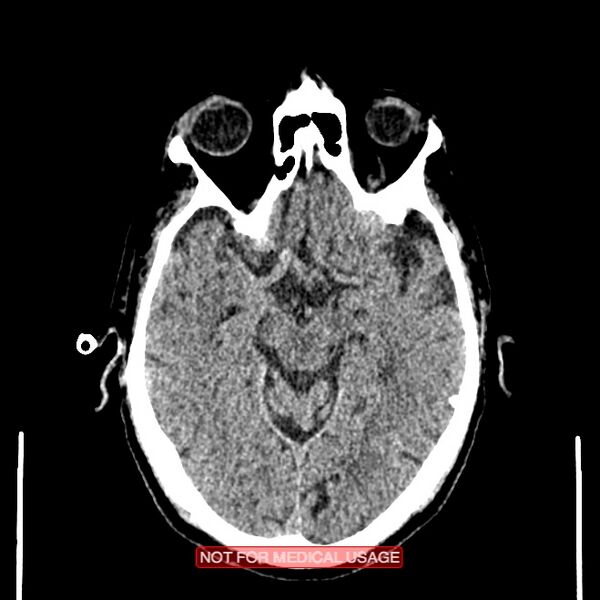 File:Artery of Percheron infarction (Radiopaedia 28679-28967 Axial non-contrast 48).jpg