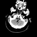 Artery of Percheron territory infarct (Radiopaedia 77456).jpg