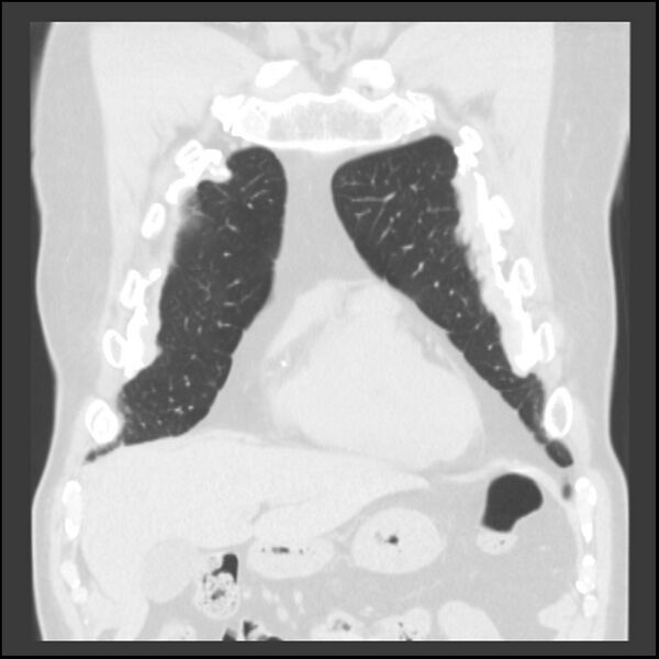 File:Asbestos-related pleural plaques (Radiopaedia 39069-41255 Coronal lung window 71).jpg