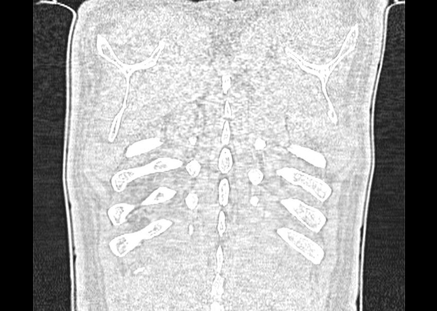 Asbestos pleural placques (Radiopaedia 57905-64872 Coronal lung window 283).jpg