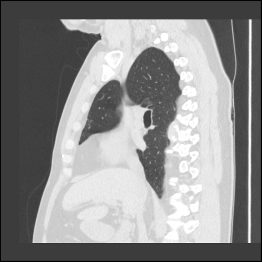 Asbestosis (Radiopaedia 45002-48961 Sagittal lung window 78).jpg