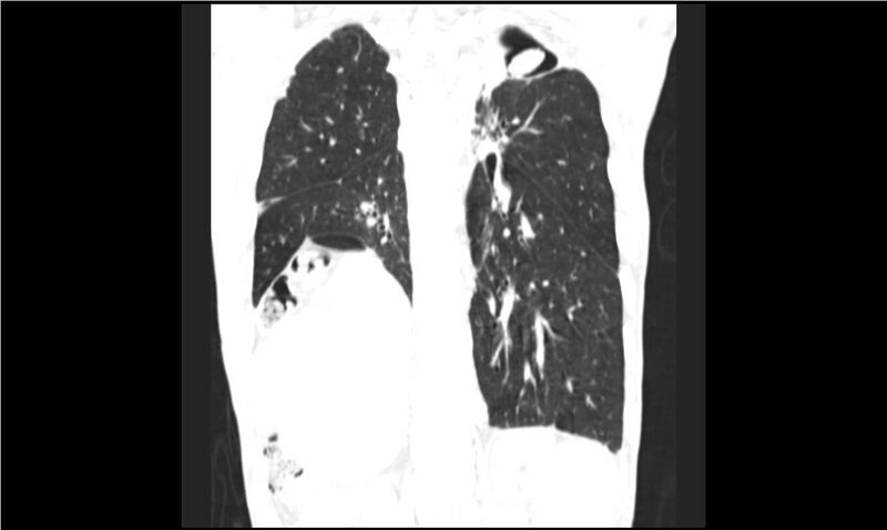 File:Aspergilloma (Radiopaedia 20788-20701 Coronal lung window 13).jpg