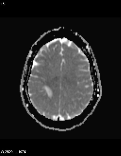 File:Astroblastoma (Radiopaedia 39792-42217 Axial ADC 14).jpg