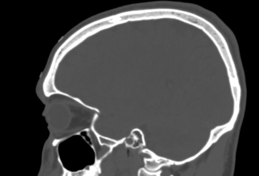 Asymptomatic occipital spur (Radiopaedia 87753-104201 Sagittal bone window 206).jpg