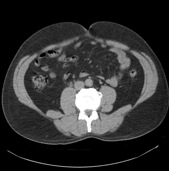 File:Atrophic kidney due to severe chronic obstructive hydronephrosis (Radiopaedia 40828-43474 Axial non-contrast 17).jpg