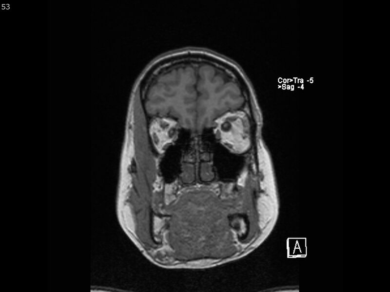 File:Atypical meningioma - intraosseous (Radiopaedia 64915-74572 Coronal T1 53).jpg