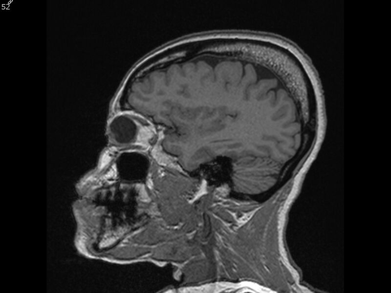 File:Atypical meningioma - intraosseous (Radiopaedia 64915-74572 Sagittal T1 52).jpg