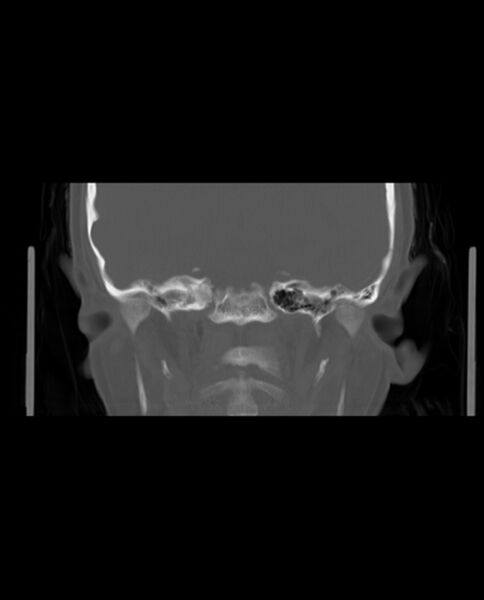 File:Automastoidectomy with labyrinthine fistula (Radiopaedia 84143-99411 Coronal non-contrast 86).jpg