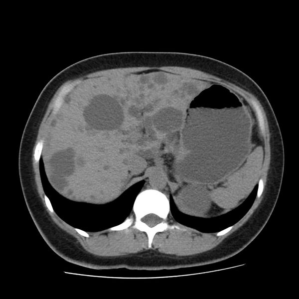 File:Autosomal dominant polycystic kidney disease (Radiopaedia 23061-23093 Axial non-contrast 15).jpg