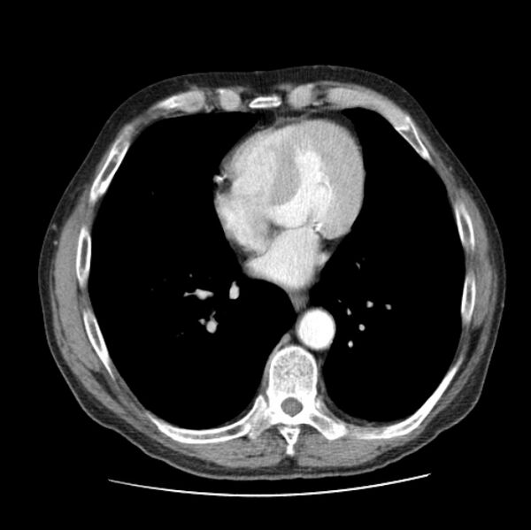 File:Autosomal dominant polycystic kidney disease (Radiopaedia 27851-28094 B 39).jpg