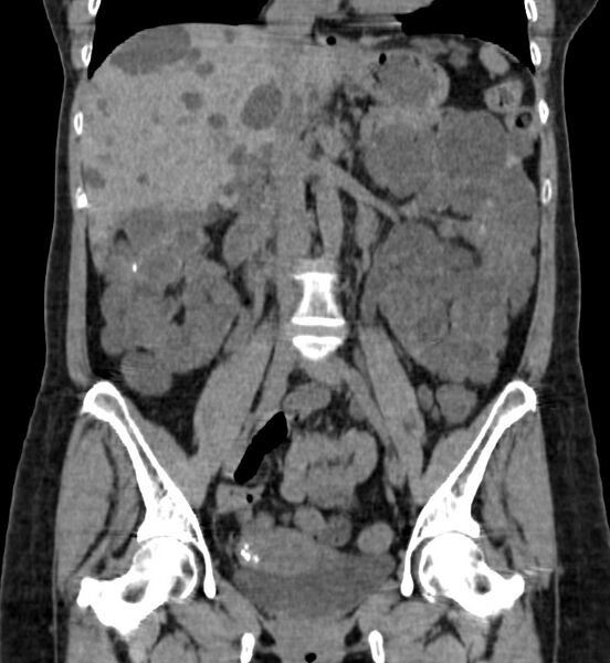 File:Autosomal dominant polycystic kidney disease (Radiopaedia 41918-44922 Coronal non-contrast 21).jpg