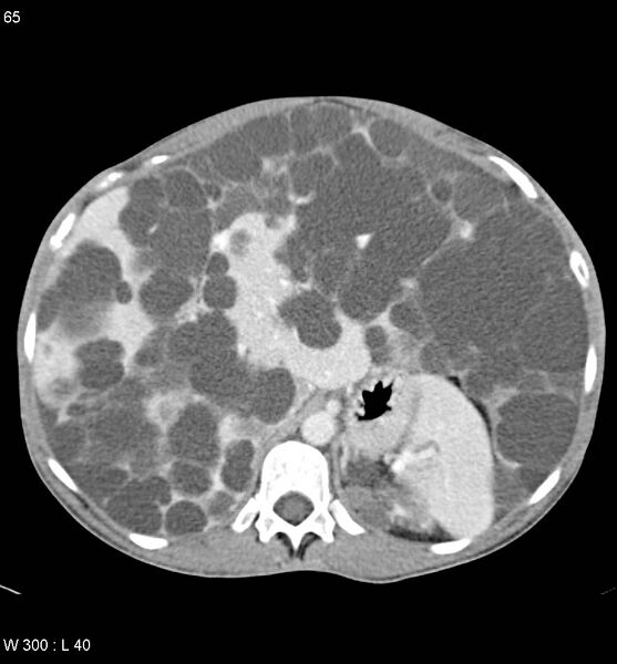 File:Autosomal dominant polycystic kidney disease with extensive hepatic involvement (Radiopaedia 5204-6971 B 7).jpg