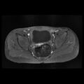 Avascular necrosis of the hip (Radiopaedia 29563-30067 Axial T1 C+ fat sat 2).jpg