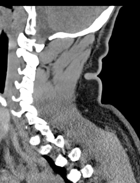 File:Axis peg fracture (type 3) and atlas lateral mass (type 4) fracture (Radiopaedia 37474-39324 D 27).png