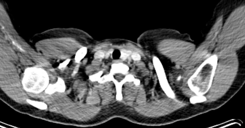 Azygos continuation of the inferior vena cava (Radiopaedia 57019-63891 A 2).jpg