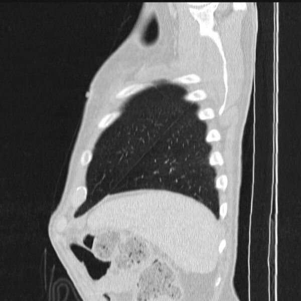 File:Azygos lobe (Radiopaedia 38259-40275 lung window 88).jpg