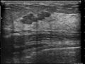BIRADS IV lesion (Radiopaedia 52907).jpg