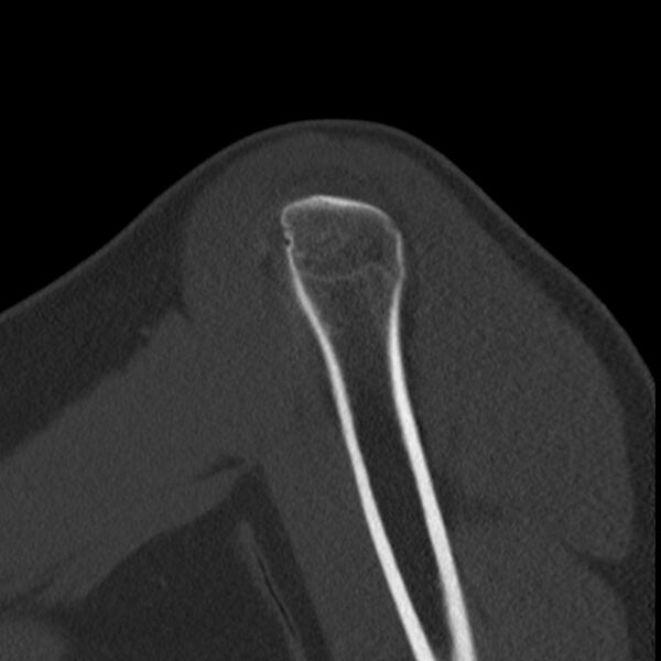 File:Bankart lesion (Radiopaedia 22771-22798 Sagittal bone window 6).jpg