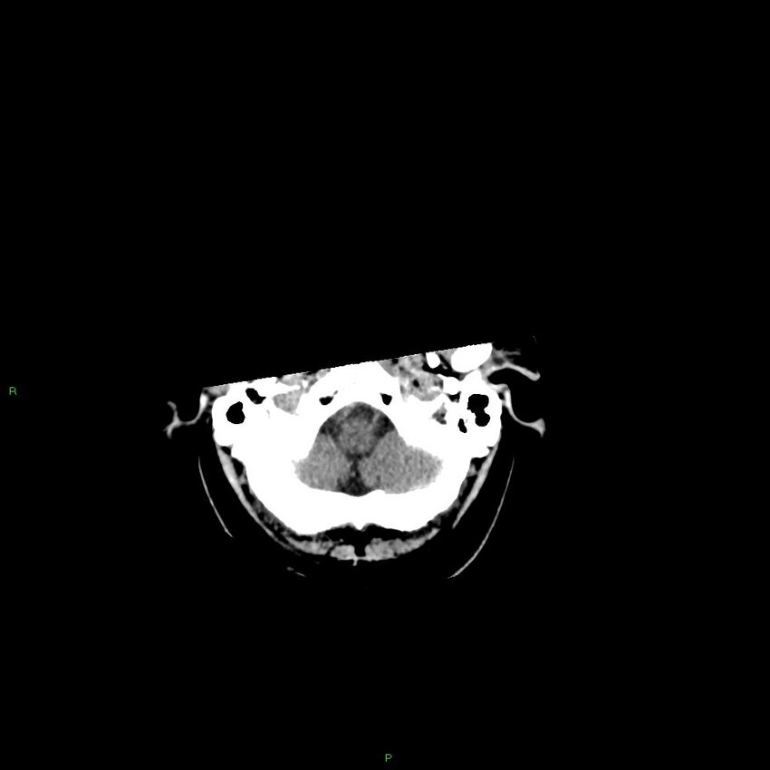 Basal ganglia hemorrhage (Radiopaedia 58346-65467 Axial non-contrast 50).jpg